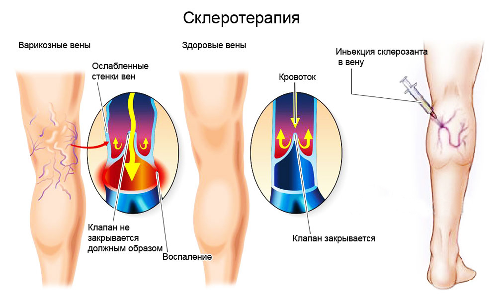 Схема лечения варикоза